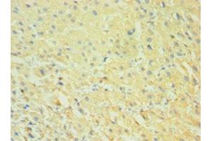 Immunohistochemistry of paraffin-embedded human liver cancer using ABIN7146296 at dilution of 1:100 (CALHM1 抗体  (AA 202-346))