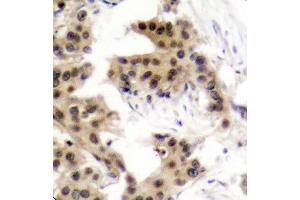 Immunohistochemistry of paraffin-embedded human breast carcinoma using Phospho-NFKB1-S893 antibody (ABIN2988205). (NFKB1 抗体  (pSer893))