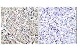 Immunohistochemical analysis of paraffin-embedded human breast carcinoma tissue, using NF-κB p65 (Phospho-Ser529) antibody (E011217). (NF-kB p65 抗体  (pSer529))