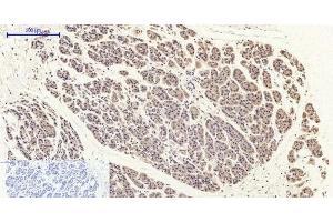 Immunohistochemistry of paraffin-embedded Human stomach cancer tissue with Phospho-FAK (Tyr397) Polyclonal Antibody at dilution of 1:200 (FAK 抗体  (pTyr397))