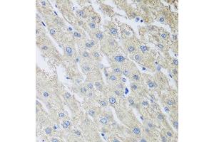 Immunohistochemistry of paraffin-embedded human liver cancer using MLKL antibody at dilution of 1:100 (40x lens). (MLKL 抗体)