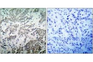 Immunohistochemistry analysis of paraffin-embedded human breast carcinoma tissue, using p53 (Ab-15) Antibody. (p53 抗体  (AA 6-55))