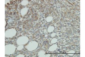 Immunoperoxidase of monoclonal antibody to PROCR on formalin-fixed paraffin-embedded human malignant lymphoma, diffuse large B tissue. (PROCR 抗体  (AA 1-238))