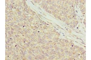 Immunohistochemistry of paraffin-embedded human ovarian cancer using ABIN7162575 at dilution of 1:100 (Pancreatic Progenitor Cell Differentiation and Proliferation Factor-Like Protein (PPDPFL) (AA 1-81) 抗体)