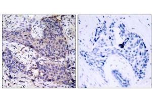 Immunohistochemical analysis of paraffin-embedded human breast carcinoma tissue using BAD (Ab-136) antibody (E021063). (BAD 抗体)