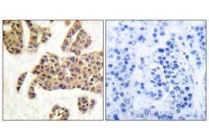 Immunohistochemical analysis of paraffin-embedded human breast carcinoma tissue using BAD (Phospho-Ser91/128) antibody (left)or the same antibody preincubated with blocking peptide (right). (BAD 抗体  (pSer91, pSer128))
