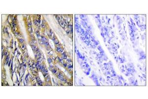 Immunohistochemistry analysis of paraffin-embedded human colon carcinoma tissue, using DGKH antibody. (DGKH 抗体  (Internal Region))