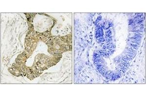 Immunohistochemistry analysis of paraffin-embedded human breast carcinoma tissue, using p90 RSK (Ab-380) Antibody. (RPS6KA3 抗体  (AA 346-395))