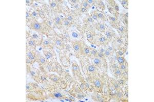 Immunohistochemistry of paraffin-embedded human liver cancer using PTGS1 antibody at dilution of 1:100 (40x lens). (PTGS1 抗体)