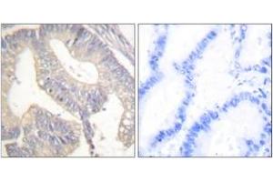 Immunohistochemistry analysis of paraffin-embedded human colon carcinoma tissue, using Gastrin Antibody. (Gastrin 抗体  (AA 52-101))