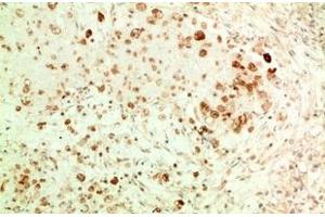 Immunohistochemistry of paraffin-embedded Human ovarian carcinoma tissue using ATG5 Monoclonal Antibody at dilution of 1:200. (ATG5 抗体)
