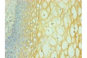 Immunohistochemical of paraffin-embedded human cervical using ABIN7156588 at dilution of 1:200 (Interferon gamma 抗体)