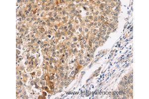 Immunohistochemistry of Human lung cancer using MAPK9 Polyclonal Antibody at dilution of 1:30 (JNK2 抗体)