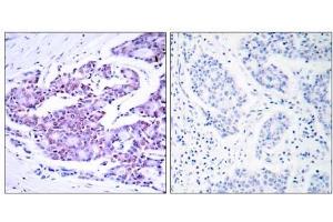 Immunohistochemical analysis of paraffin- embedded human breast carcinoma tissue using NF-κB p65 (Ab-468) antibody (E021013). (NF-kB p65 抗体)
