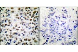 Immunohistochemistry analysis of paraffin-embedded human breast carcinoma, using POLR2A (Phospho-Ser1619) Antibody. (POLR2A/RPB1 抗体  (pSer1619))