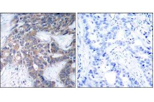 Immunohistochemical analysis of paraffin-embedded human breast carcinoma tissue, using MEK1 (phospho-Ser217) antibody (E011205). (MEK1 抗体  (pSer217))
