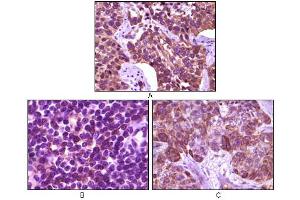 Immunohistochemical analysis of paraffin-embedded human lung carcinoma (A), lymph tissue (B) and skin carcinoma (C), showing membrane localization using BLK mouse mAb with DAB staining. (BLK 抗体)