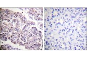 Immunohistochemistry analysis of paraffin-embedded human breast carcinoma tissue, using Histone H4 (Acetyl-Lys12) Antibody. (Histone H4 抗体  (acLys12))