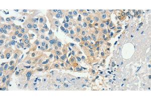 Immunohistochemistry of paraffin-embedded Human breast cancer tissue using DGK beta Polyclonal Antibody at dilution 1:60 (DGKB 抗体)