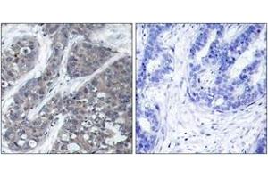 Immunohistochemistry analysis of paraffin-embedded human breast carcinoma tissue, using PYK2 (Ab-402) Antibody. (PTK2B 抗体  (AA 369-418))