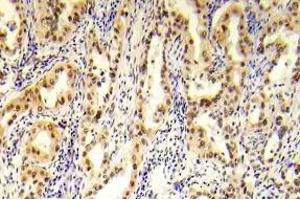 Immunohistochemistry (IHC) analyzes of p-Tsc2 antibody in paraffin-embedded human prostate carcinoma tissue. (Tuberin 抗体  (pSer1254))