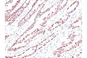 Formalin-fixed, paraffin-embedded human colon carcinoma stained with p57 antibody (KP10). (P57 抗体)