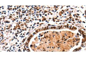 Immunohistochemistry of paraffin-embedded Human stomach cancer tissue using DNMT3A Polyclonal Antibody at dilution 1:65 (DNMT3A 抗体)