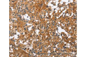 Immunohistochemistry of Human liver cancer using BGN Polyclonal Antibody at dilution of 1:50 (Biglycan 抗体)