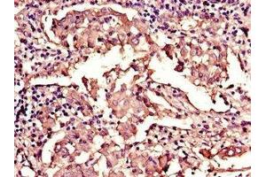 Immunohistochemistry of paraffin-embedded human lung cancer using ABIN7157854 at dilution of 1:100 (Lamin B1 抗体  (AA 385-552))