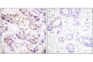 Immunohistochemistry analysis of paraffin-embedded human breast carcinoma tissue, using PKC alpha (Ab-638) Antibody. (PKC alpha 抗体  (AA 606-655))