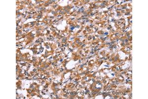 Immunohistochemistry of Human gastric cancer using GPC6 Polyclonal Antibody at dilution of 1:40 (Glypican 6 抗体)