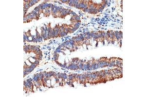 Immunohistochemistry of paraffin-embedded human colon carcinoma using P Rabbit mAb (ABIN1682842, ABIN3019312, ABIN3019313 and ABIN7101749) at dilution of 1:100 (40x lens). (PAWR 抗体)