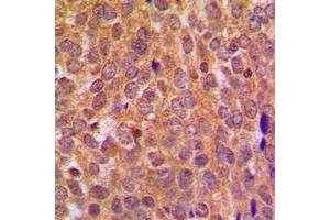 Immunohistochemical analysis of AKT staining in human breast cancer formalin fixed paraffin embedded tissue section. (AKT1 抗体  (Center))