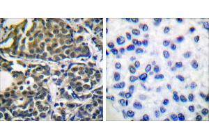 Peptide - +Immunohistochemical analysis of paraffin-embedded human breast carcinoma tissue using HSP90B (Ab-254) antibody (#B0013). (HSP90AB1 抗体  (Ser254))