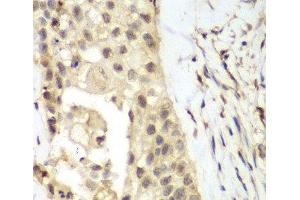 Immunohistochemistry of paraffin-embedded Human lung cancer using FGFR1 Polyclonal Antibody at dilution of 1:100 (40x lens). (FGFR1 抗体)