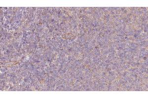 ABIN6273065 at 1/100 staining Human lymph cancer tissue by IHC-P. (PKLR 抗体  (Internal Region))