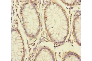 Immunohistochemistry of paraffin-embedded human colon cancer using ABIN7166047 at dilution of 1:100 (S1A14 (AA 1-104) 抗体)