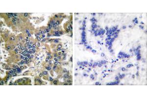 Cl-peptide - +Immunohistochemical analysis of paraffin-embedded human lung carcinoma tissue using Caspase 1 (Cleaved-Asp210) antibody. (Caspase 1 抗体  (Cleaved-Asp210))