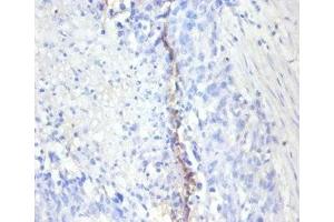 Immunohistochemistry of paraffin-embedded human bladder cancer using ABIN7164742 at dilution of 1:100 (Ki-67 抗体  (AA 3120-3256))