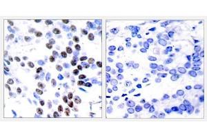 Immunohistochemical analysis of paraffin-embedded human breast carcinoma tissue using c-Jun (Ab-93) antibody (E021022). (C-JUN 抗体)