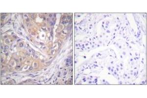 Immunohistochemistry analysis of paraffin-embedded human breast carcinoma, using Lck (Phospho-Tyr505) Antibody. (LCK 抗体  (pTyr505))