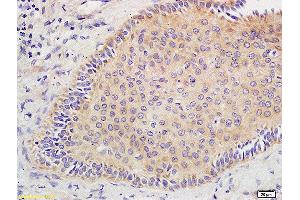 Formalin-fixed and paraffin embedded human oral squamous cell carcinoma tissue labeled with Anti CD44V10 Polyclonal Antibody, Unconjugated  at 1:400 followed by conjugation to the secondary antibody and DAB staining. (CD44v10 (AA 218-227) 抗体)