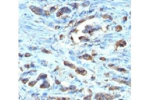 IHC testing of FFPE gastric carcinoma with Cdc20 antibody (clone AR12) (CDC20 抗体)