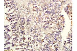 Formalin-fixed and paraffin embedded human colon carcinoma labeled with Anti-TGF-beta-2 Polyclonal Antibody, Unconjugated 1:300 followed by conjugation to the secondary antibody and DAB staining (TGF beta 2 Propeptide (AA 154-197) 抗体)