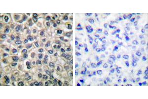 Peptide - +Immunohistochemical analysis of paraffin-embedded human breast carcinoma tissue using Catenin-γ antibody. (JUP 抗体)