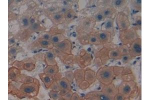 Detection of CK4 in Human Liver cancer Tissue using Polyclonal Antibody to Cytokeratin 4 (CK4) (KRT4 抗体  (AA 152-457))
