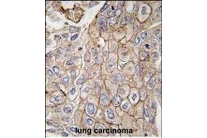 Formalin-fixed and paraffin-embedded human lung carcinoma tissue reacted with CLIC1 antibody, which was peroxidase-conjugated to the secondary antibody, followed by DAB staining. (CLIC1 抗体)
