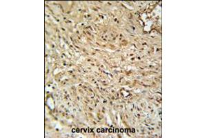 RPA43 Antibody immunohistochemistry analysis in formalin fixed and paraffin embedded human cervix carcinoma followed by peroxidase conjugation of the secondary antibody and DAB staining. (TWIST Neighbor 抗体  (C-Term))