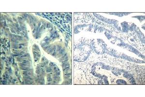 Immunohistochemical analysis of paraffin-embedded human colon carcinoma tissue using CDK6 (phospho-Tyr24) Antibody (E011543). (CDK6 抗体  (pTyr24))