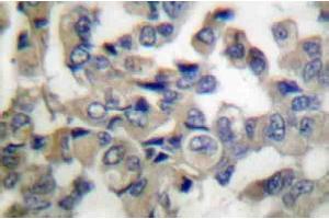 Immunohistochemistry Analysis: AP20201PU-N Synaptotagmin antibody staining of Paraffin-Embedded Human breast carcinoma tissue. (SYT1 抗体)